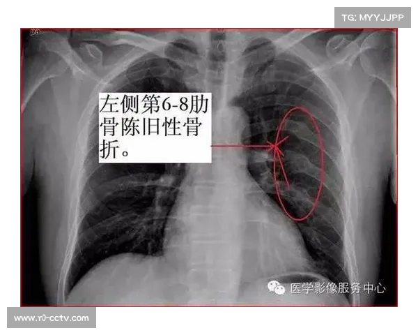 波鸿后卫霍夫曼遭遇肋骨骨折并引发肺部重伤 宣布赛季提前报销